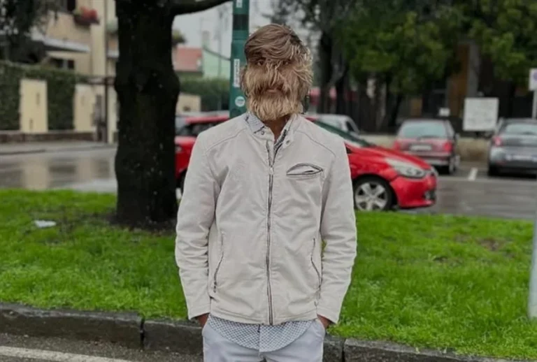 Ο πιο τριχωτός άνθρωπος στον κόσμο και το σπάνιο «σύνδρομο του λυκανθρώπου» 41e053c0-50d4-40dc-b122-988530e5e3e8