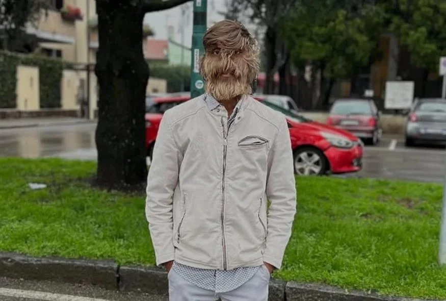 Ο πιο τριχωτός άνθρωπος στον κόσμο και το σπάνιο «σύνδρομο του λυκανθρώπου»