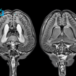 Οι επιστήμονες ανακάλυψαν ότι ο εγκέφαλος κυριολεκτικά «τρώει τον εαυτό του» όταν δεν κοιμόμαστε αρκετά
