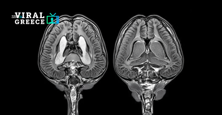 Οι επιστήμονες ανακάλυψαν ότι ο εγκέφαλος κυριολεκτικά «τρώει τον εαυτό του» όταν δεν κοιμόμαστε αρκετά αδςδ