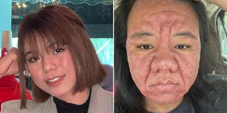 Γυναίκα αποκαλύπτει πώς η εγκυμοσύνη άλλαξε δραματικά το πρόσωπο της ( VIDEO )