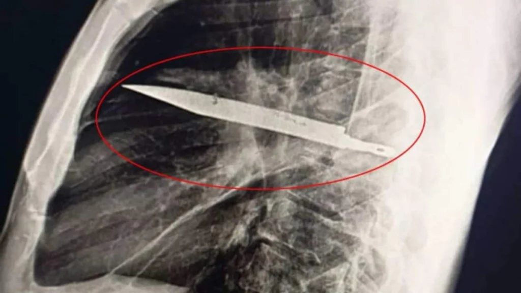 Σοκ στην Τανζανία: 44χρονος είχε μαχαίρι καρφωμένο στο στήθος του επί οκτώ χρόνια ( VIDEO )