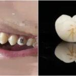 Το νέο… δαγκωτό trend στην Κίνα: Τα τατουάζ στα δόντια που «τρελαίνουν» τους νέους