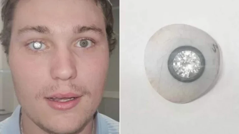 Έχασε το μάτι του και το αντικατέστησε με... διαμάντι diamond-eye