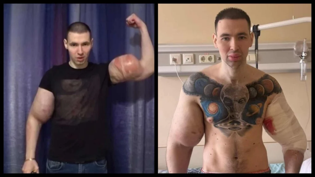 Ο «Ρώσος Ποπάι» κινδυνεύει να χάσει και τα δύο του χέρια μετά τις ενέσεις βαζελίνης