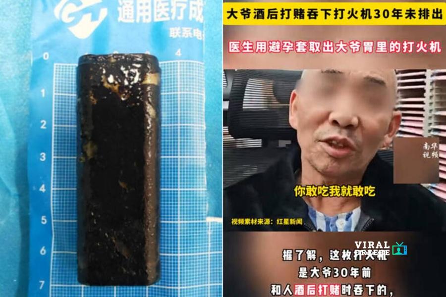 Ξέχασε ότι είχε καταπιεί αναπτήρα πριν 30 χρόνια – Οι γιατροί τον αφαίρεσαν και… λειτουργούσε ακόμα 418a8ff21f14df9e787c2c62da84881c XL